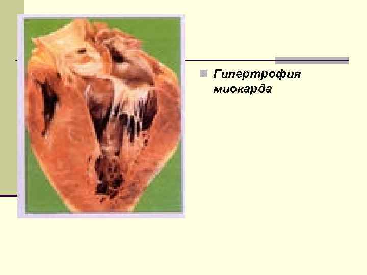 n n Гипертрофия миокарда 
