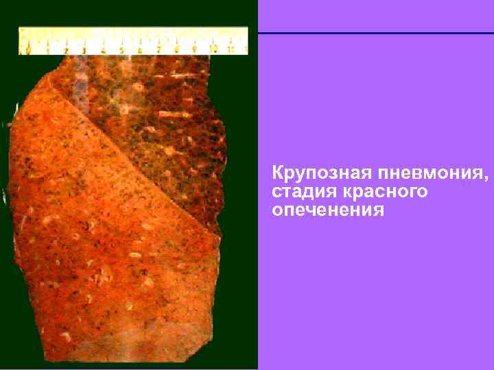 Крупозная пневмония, стадия красного опеченения Copyright © 2004 Pearson Education, Inc. , publishing as