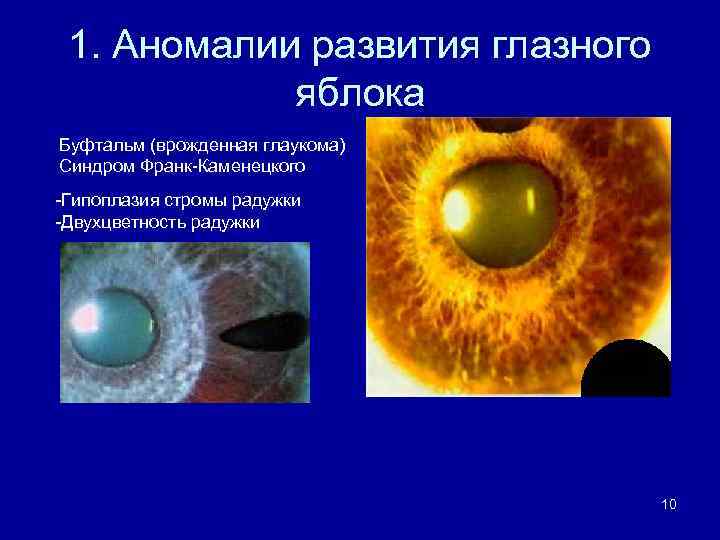 1. Аномалии развития глазного яблока Буфтальм (врожденная глаукома) Синдром Франк-Каменецкого -Гипоплазия стромы радужки -Двухцветность