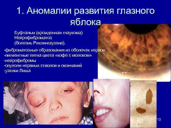 1. Аномалии развития глазного яблока Буфтальм (врожденная глаукома) Нейрофиброматоз (болезнь Реклингаузена). -фиброматозные образования из