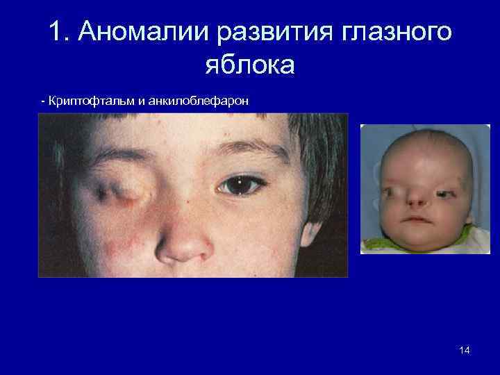 1. Аномалии развития глазного яблока - Криптофтальм и анкилоблефарон 14 