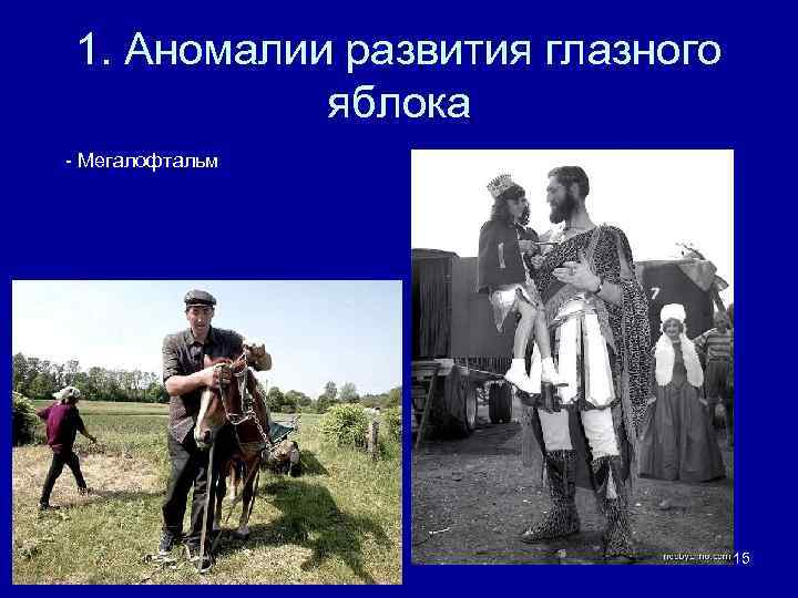 1. Аномалии развития глазного яблока - Мегалофтальм 15 