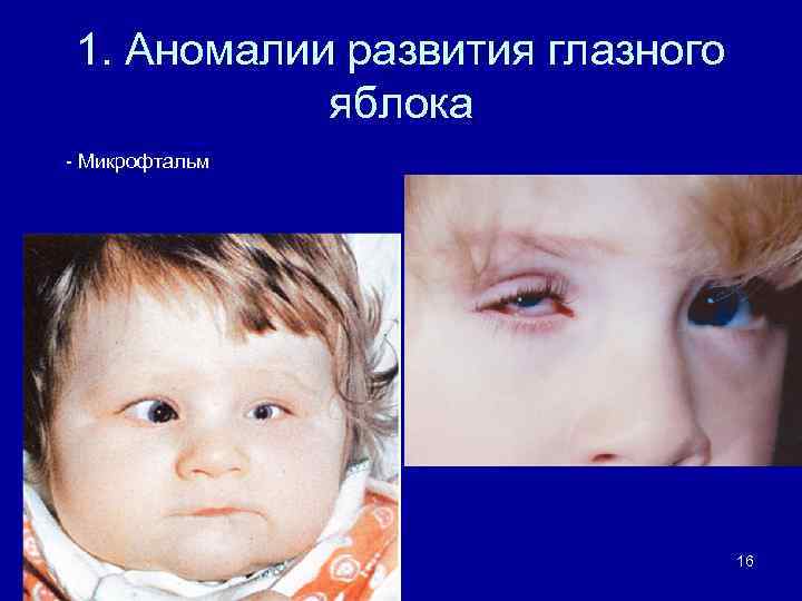 1. Аномалии развития глазного яблока - Микрофтальм 16 