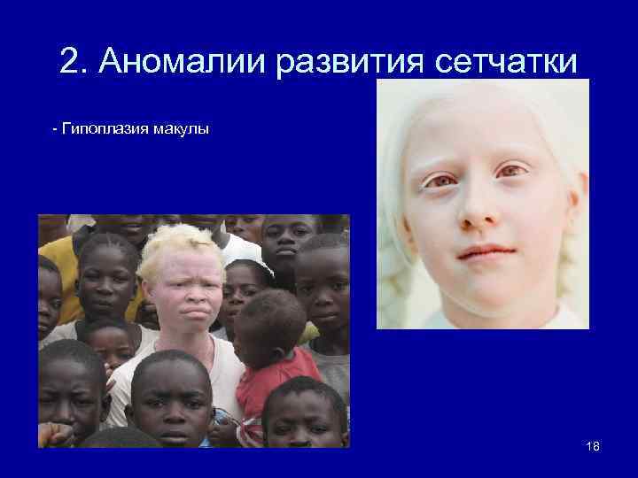 2. Аномалии развития сетчатки - Гипоплазия макулы 18 