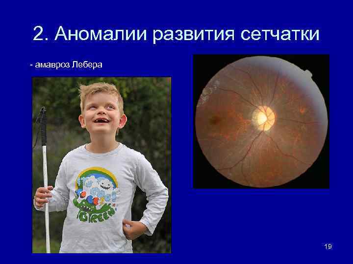 Аномалия развития зрительного нерва. Наследственная оптическая нейропатия Лебера. Атрофия зрительного нерва Лебера. Врожденный амавроз Лебера.
