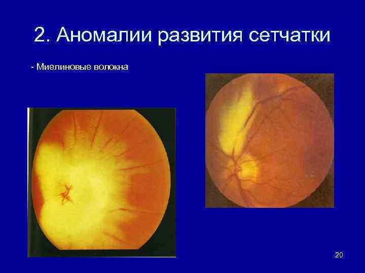 Аномалия развития зрительного нерва. Миелиновые волокна ДЗН. Миелиновые волокна зрительного нерва. Глазное дно миелиновые волокна. Миелиновые волокна диска зрительного нерва.