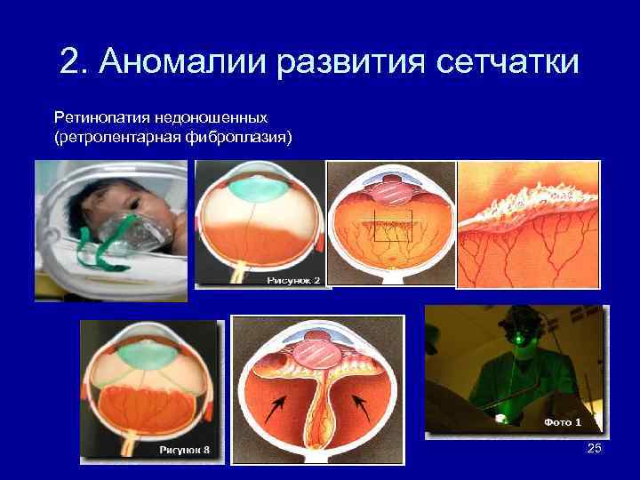 2. Аномалии развития сетчатки Ретинопатия недоношенных (ретролентарная фиброплазия) 25 