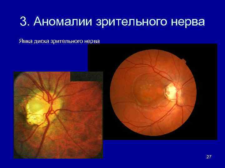 Аномалия развития зрительного нерва. Оптическая когерентная томография диска зрительного нерва. Врожденные аномалии зрительного нерва. Врожденная аномалия диска зрительного нерва миелиновые волокна. Врожденная пигментация диска зрительного нерва.