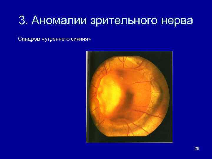 Аномалия развития зрительного нерва. Колобома зрительного нерва. Аномалии развития диска зрительного нерва. Врожденные аномалии зрительного нерва. Врожденные пороки развития зрительного нерва.
