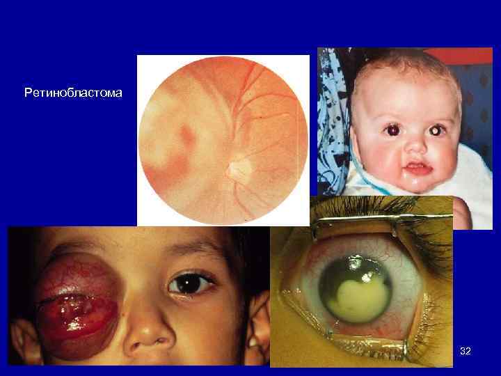 Ретинобластома 32 