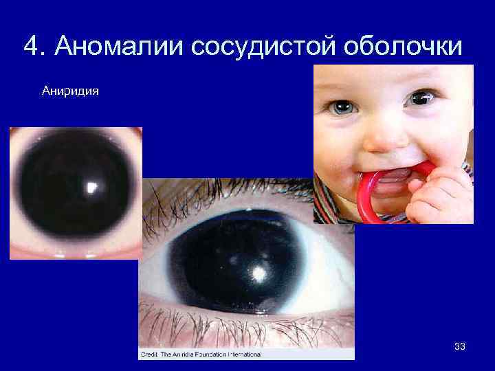 4. Аномалии сосудистой оболочки Аниридия 33 