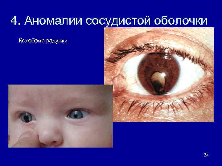 4. Аномалии сосудистой оболочки Колобома радужки 34 