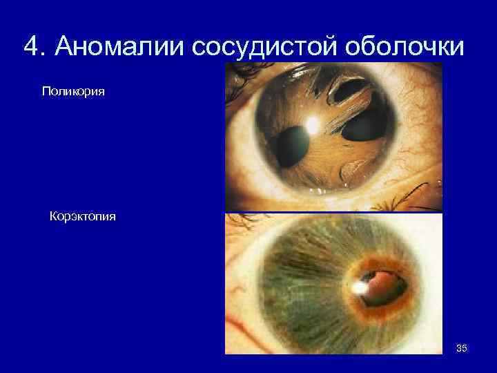 4. Аномалии сосудистой оболочки Поликория Корэктопия 35 