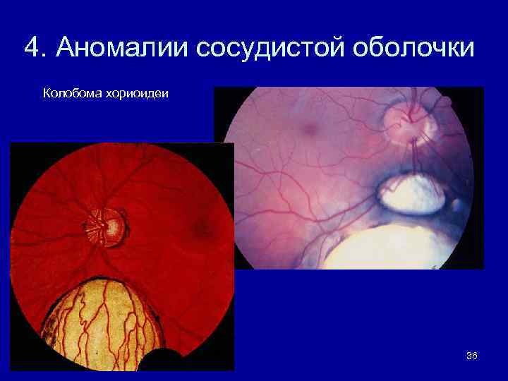 4. Аномалии сосудистой оболочки Колобома хориоидеи 36 