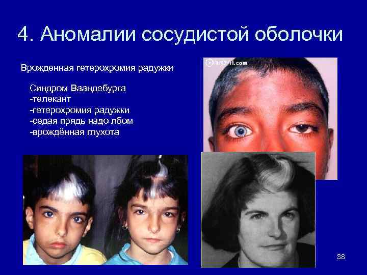 4. Аномалии сосудистой оболочки Врожденная гетерохромия радужки Синдром Ваандебурга -телекант -гетерохромия радужки -седая прядь