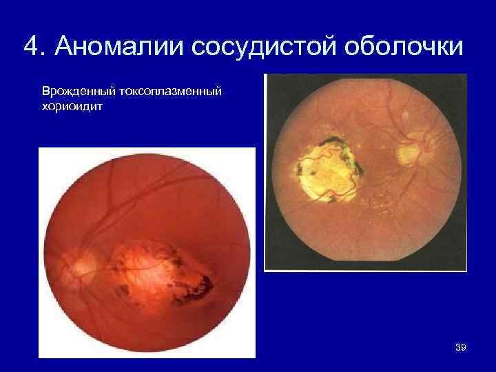 4. Аномалии сосудистой оболочки Врожденный токсоплазменный хориоидит 39 