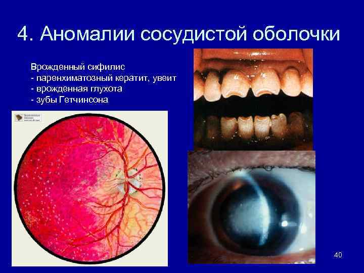 4. Аномалии сосудистой оболочки Врожденный сифилис - паренхиматозный кератит, увеит - врожденная глухота -