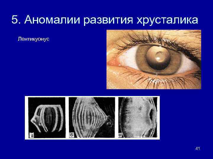 5. Аномалии развития хрусталика Лентикуонус 41 