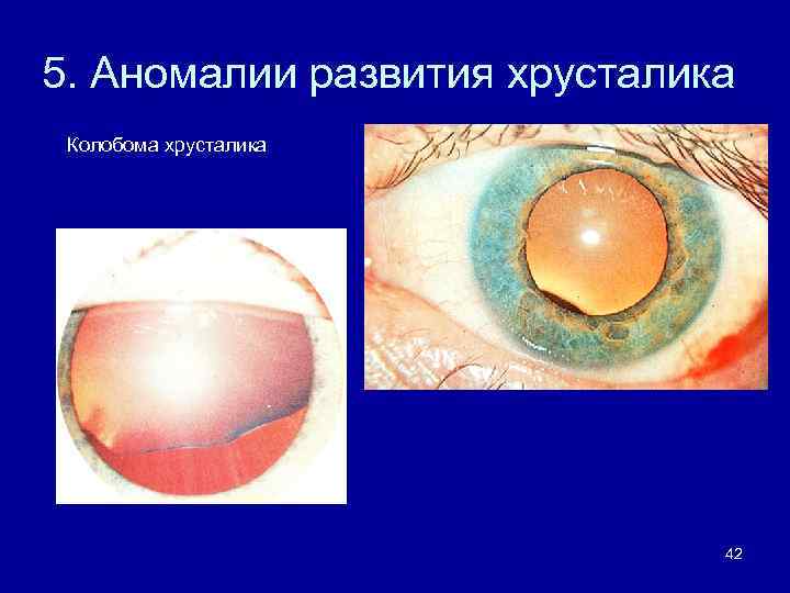 5. Аномалии развития хрусталика Колобома хрусталика 42 