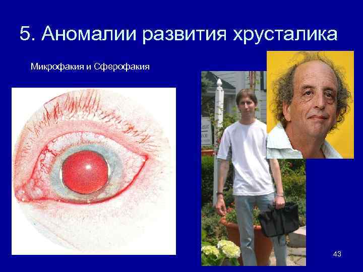 5. Аномалии развития хрусталика Микрофакия и Сферофакия 43 