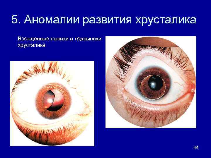5. Аномалии развития хрусталика Врожденные вывихи и подвывихи хрусталика 44 