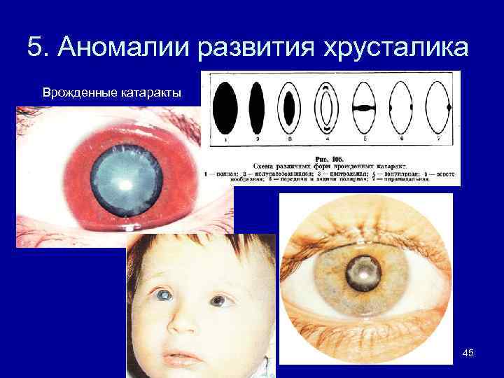 5. Аномалии развития хрусталика Врожденные катаракты 45 