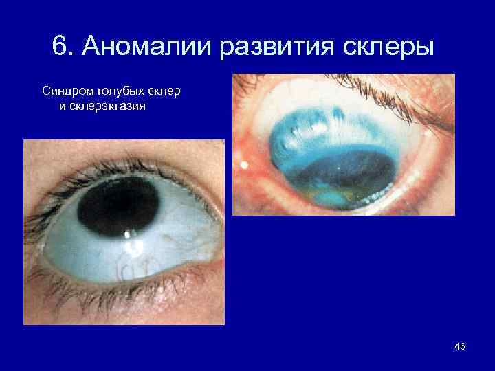 6. Аномалии развития склеры Синдром голубых склер и склерэктазия 46 