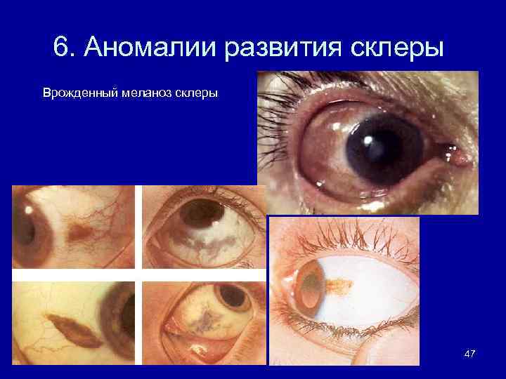 6. Аномалии развития склеры Врожденный меланоз склеры 47 