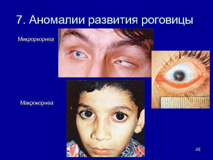 7. Аномалии развития роговицы Микроркорнеа Макрокорнеа 48 