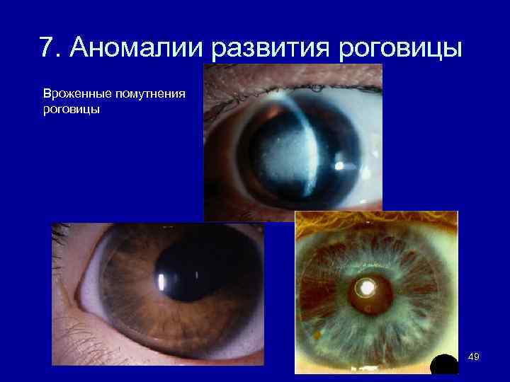 7. Аномалии развития роговицы Вроженные помутнения роговицы 49 