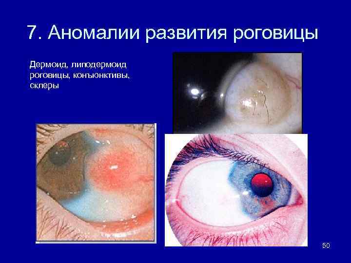 7. Аномалии развития роговицы Дермоид, липодермоид роговицы, конъюнктивы, склеры 50 