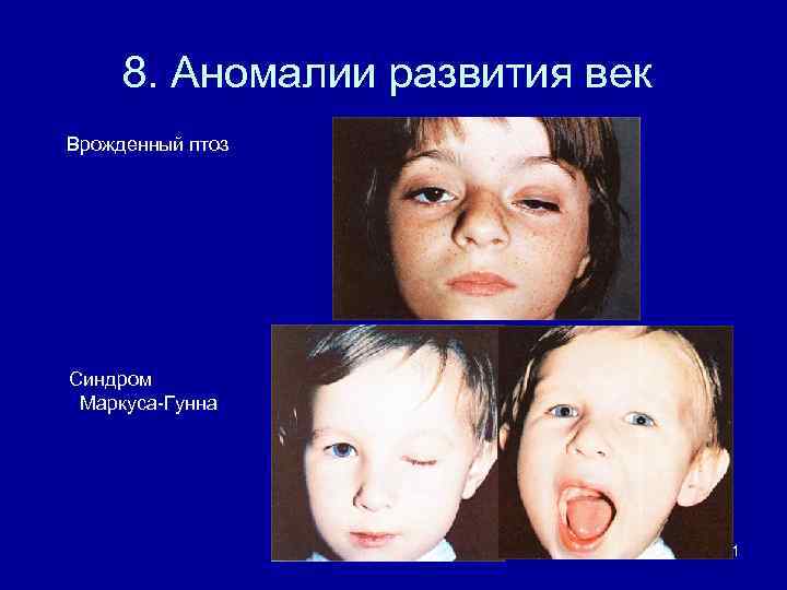 8. Аномалии развития век Врожденный птоз Синдром Маркуса-Гунна 51 