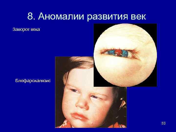 8. Аномалии развития век Заворот века Блефарохалязис 53 