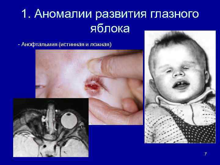 1. Аномалии развития глазного яблока - Анофтальмия (истинная и ложная) 7 