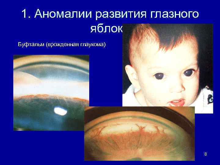 1. Аномалии развития глазного яблока Буфтальм (врожденная глаукома) 8 