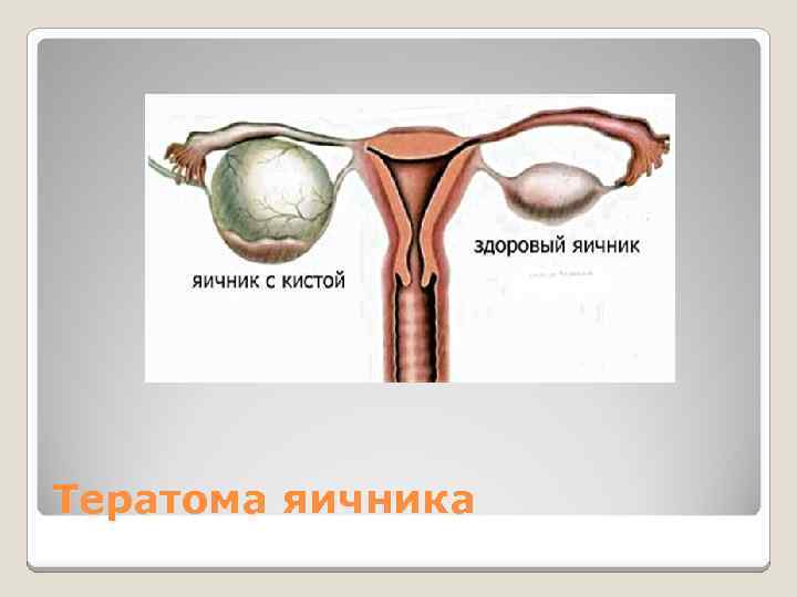 Тератома яичника 