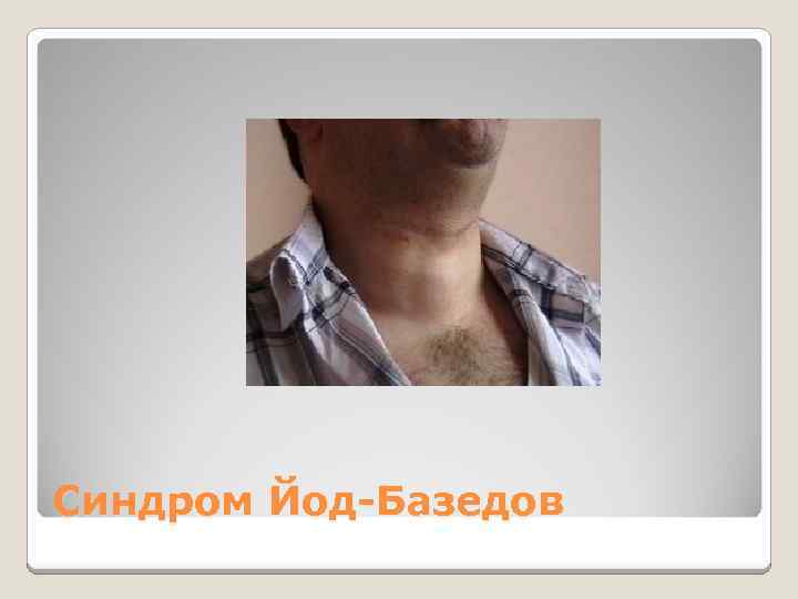 Синдром Йод-Базедов 