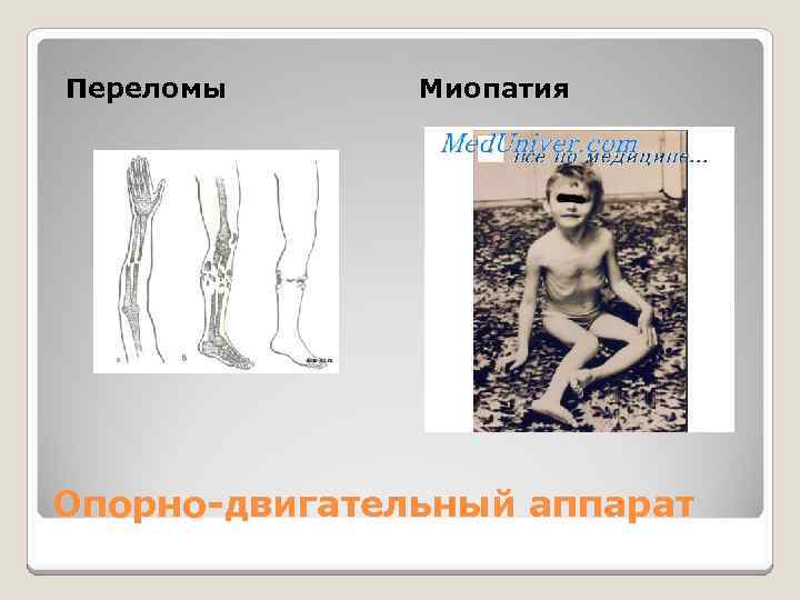 Переломы Миопатия Опорно-двигательный аппарат 
