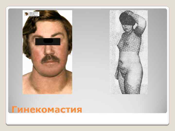 Гинекомастия 