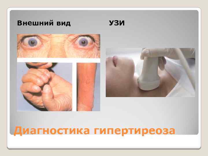 Внешний вид УЗИ Диагностика гипертиреоза 