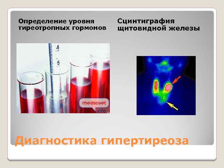 Определение уровня тиреотропных гормонов Сцинтиграфия щитовидной железы Диагностика гипертиреоза 