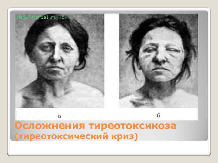 Осложнения тиреотоксикоза (тиреотоксический криз) 