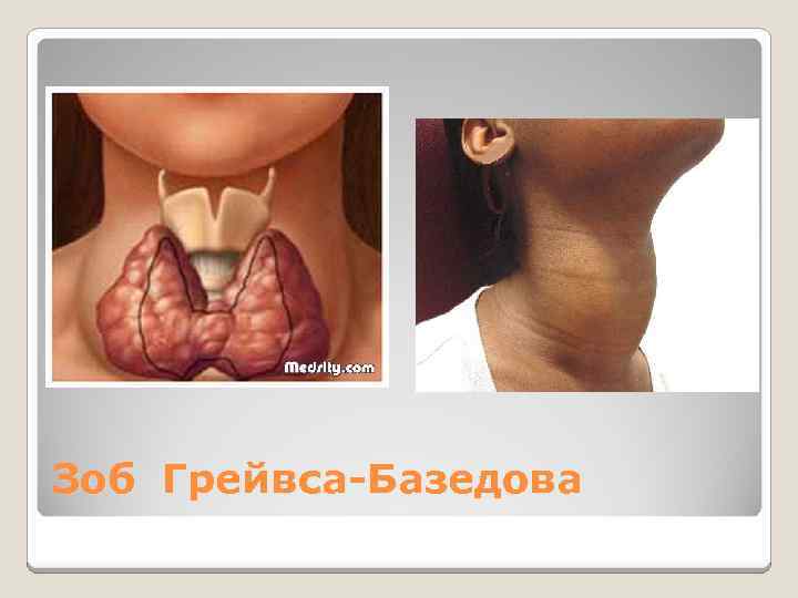 Зоб Грейвса-Базедова 