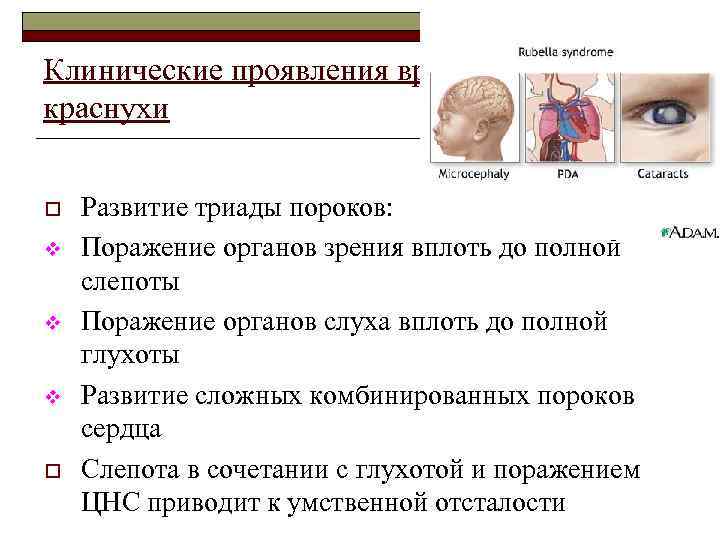 Клинические проявления врожденной краснухи o v v v o Развитие триады пороков: Поражение органов