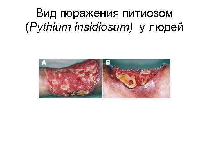 Вид поражения питиозом (Pythium insidiosum) у людей 