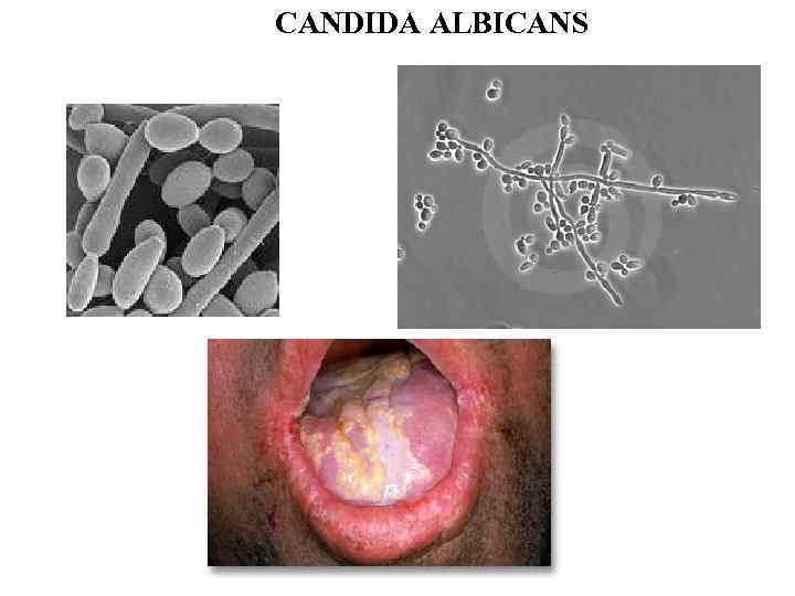 СANDIDA ALBICANS 