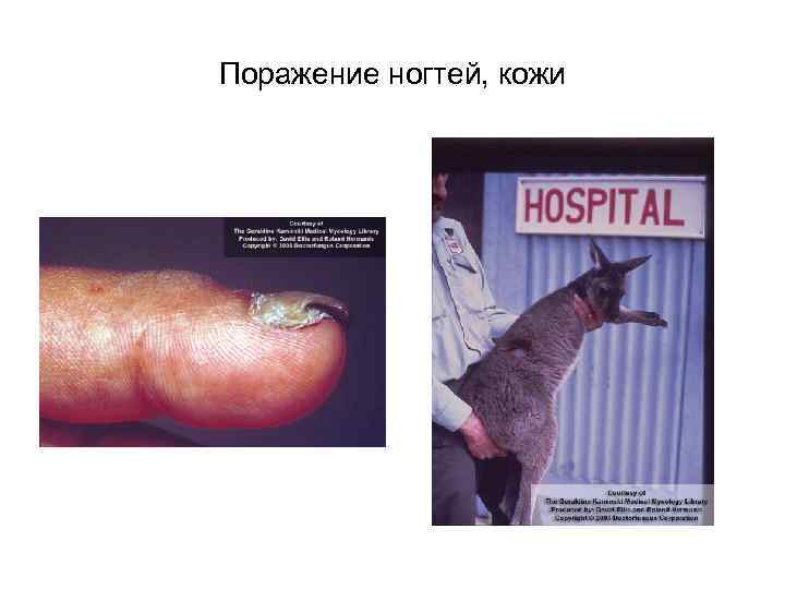 Поражение ногтей, кожи 