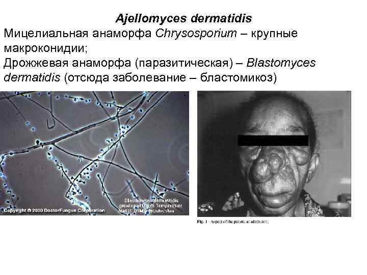 Ajellomyces dermatidis Мицелиальная анаморфа Chrysosporium – крупные макроконидии; Дрожжевая анаморфа (паразитическая) – Blastomyces dermatidis