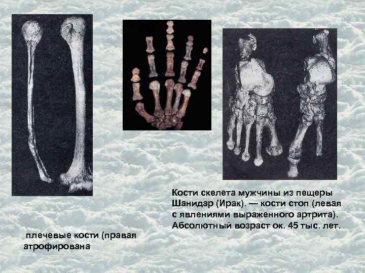  плечевые кости (правая атрофирована Кости скелета мужчины из пещеры Шанидар (Ирак). — кости