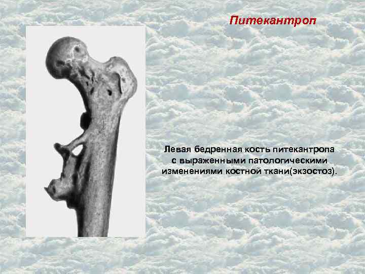 Питекантроп Левая бедренная кость питекантропа с выраженными патологическими изменениями костной ткани(экзостоз). 